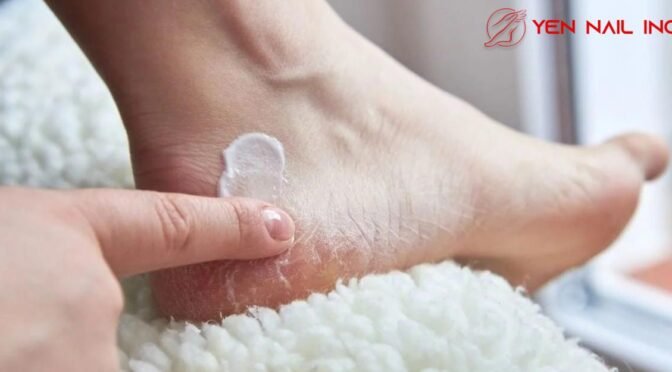 Why Do Our Feet Get Dry/Cracked?